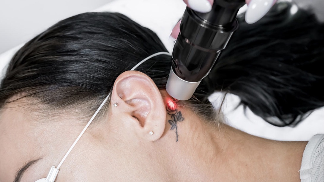 Laser Tattoo Removal